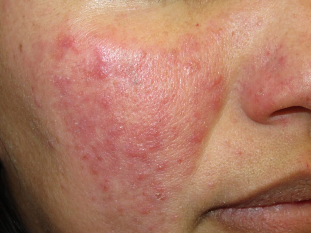 dermatologia murcia
