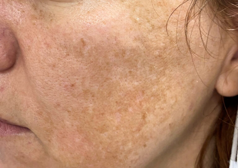 Melasma