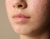 dermatologia murcia