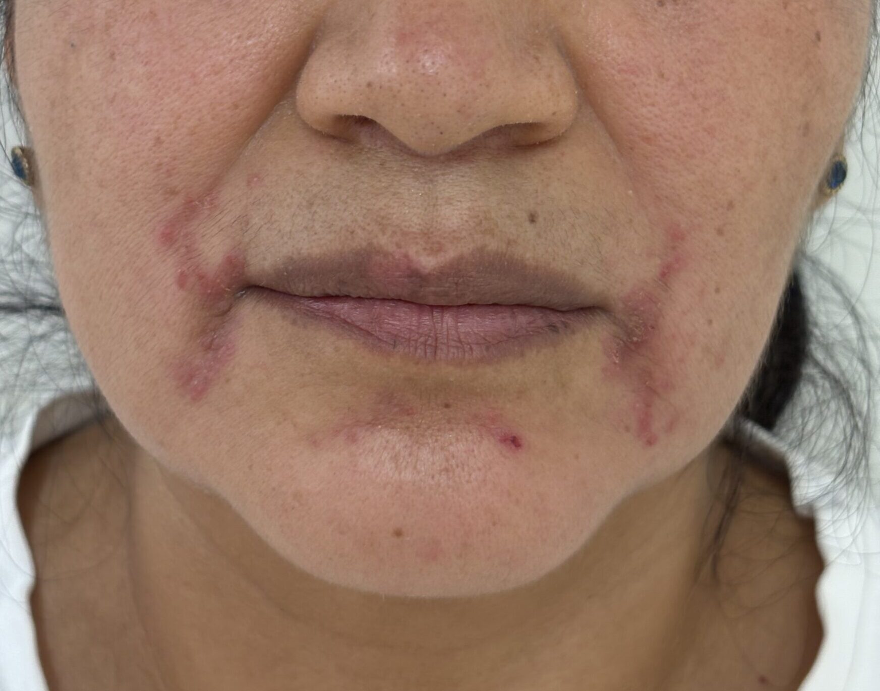 Dermatitis periorificial
