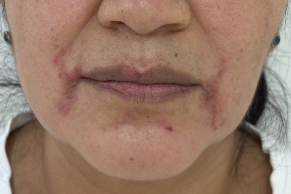 Dermatitis periorificial