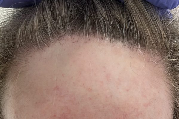 Alopecia frontal fibrosante