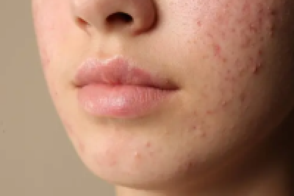 dermatologia murcia