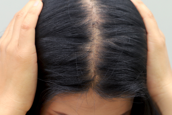 Alopecia androgenica femenina