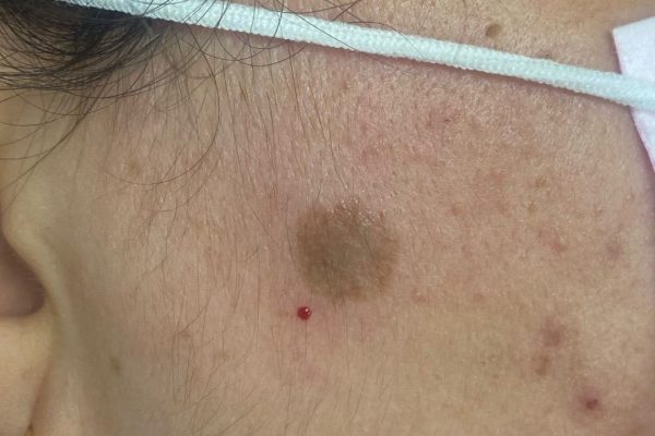 dermatologia murcia