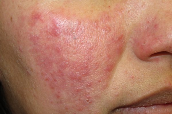 dermatologia murcia